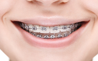 Traditional Metal Braces